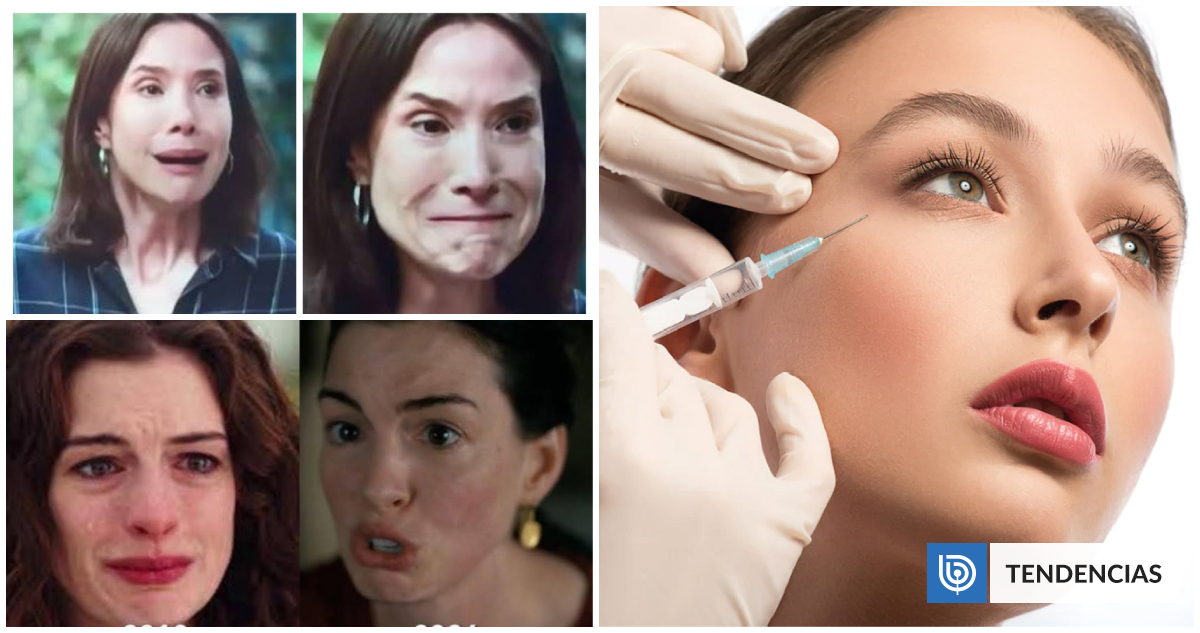 ¿Está el bótox mermando a las actrices chilenas?: «Se les pide belleza»