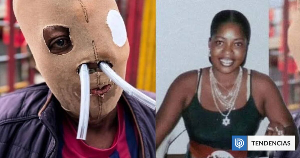 Colombiana quemada con ácido ruega por eutanasia tras 26 años de suplicio y casi 90 cirugías | Sociedad